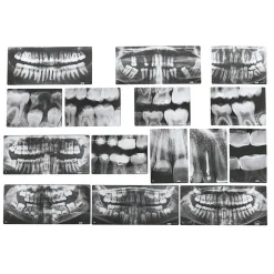 Dental X-Rays Set of 15 with Chart